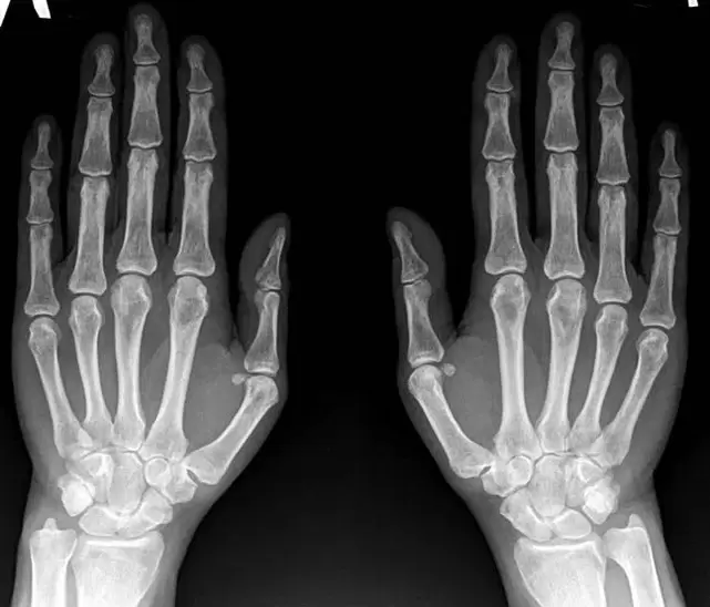 arthritis of the wrist joint on x-ray before using Hondroine