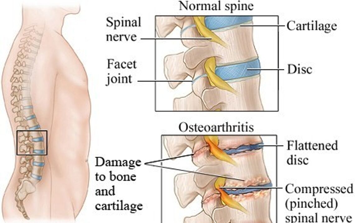 The difference between a healthy album and an album with osteochondrosis