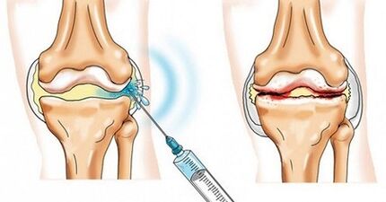 How to treat the osteoarthritis of the knee joint
