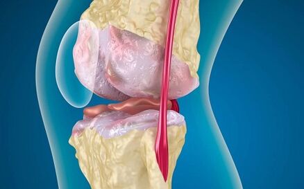 The reasons for the development of the osteoarthritis of the knee joint